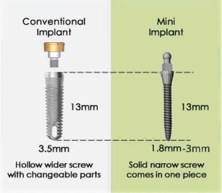 Osseointegration | Pocket Dentistry