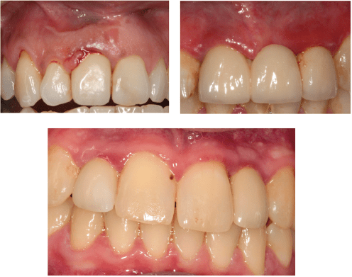 Peri-Implant Tissues | Pocket Dentistry