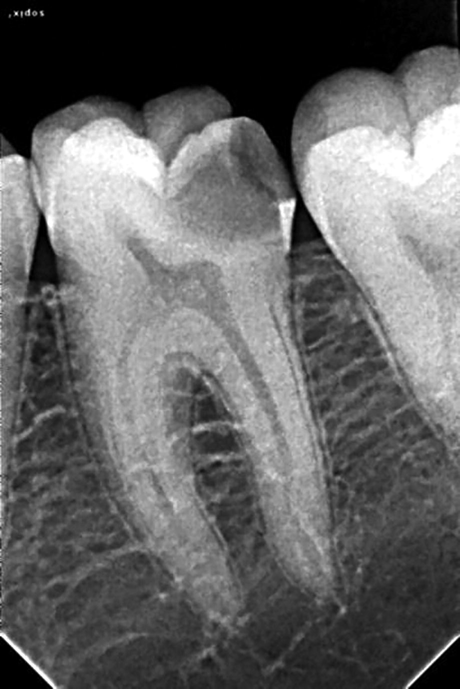 In Operative Dentistry | Pocket Dentistry