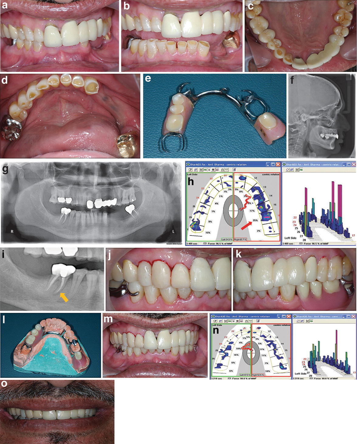 Occlusal Analysis And Force Finishing | Pocket Dentistry