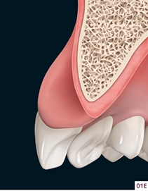 SOCKET PRESERVATION: How To Maintain Tissue Architecture | Pocket Dentistry