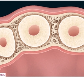 SOCKET PRESERVATION: How To Maintain Tissue Architecture | Pocket Dentistry