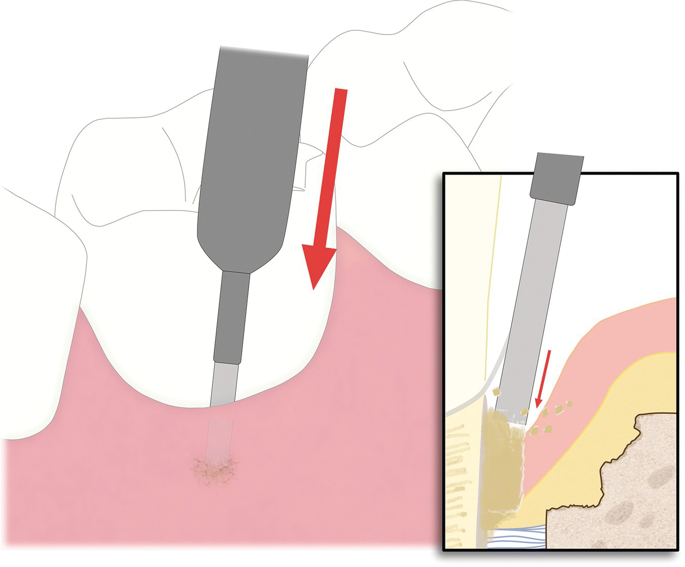 In Periodontology | Pocket Dentistry