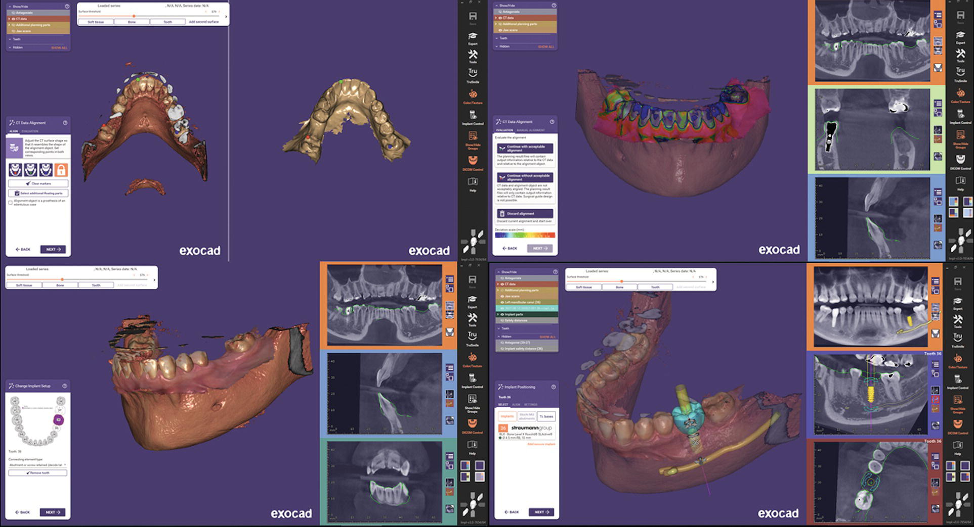 Digital Workflow In Implant Dentistry | Pocket Dentistry