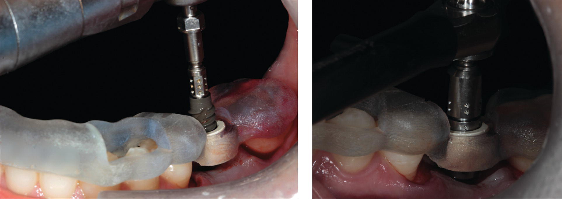 Digital Workflow In Implant Dentistry | Pocket Dentistry