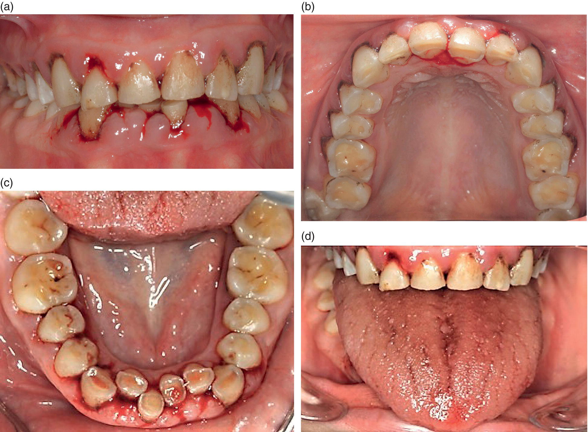 Thrombocytopenia | Pocket Dentistry