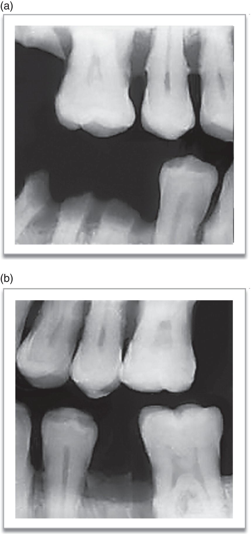 Immunosuppressants (Solid Organ Transplantation) | Pocket Dentistry