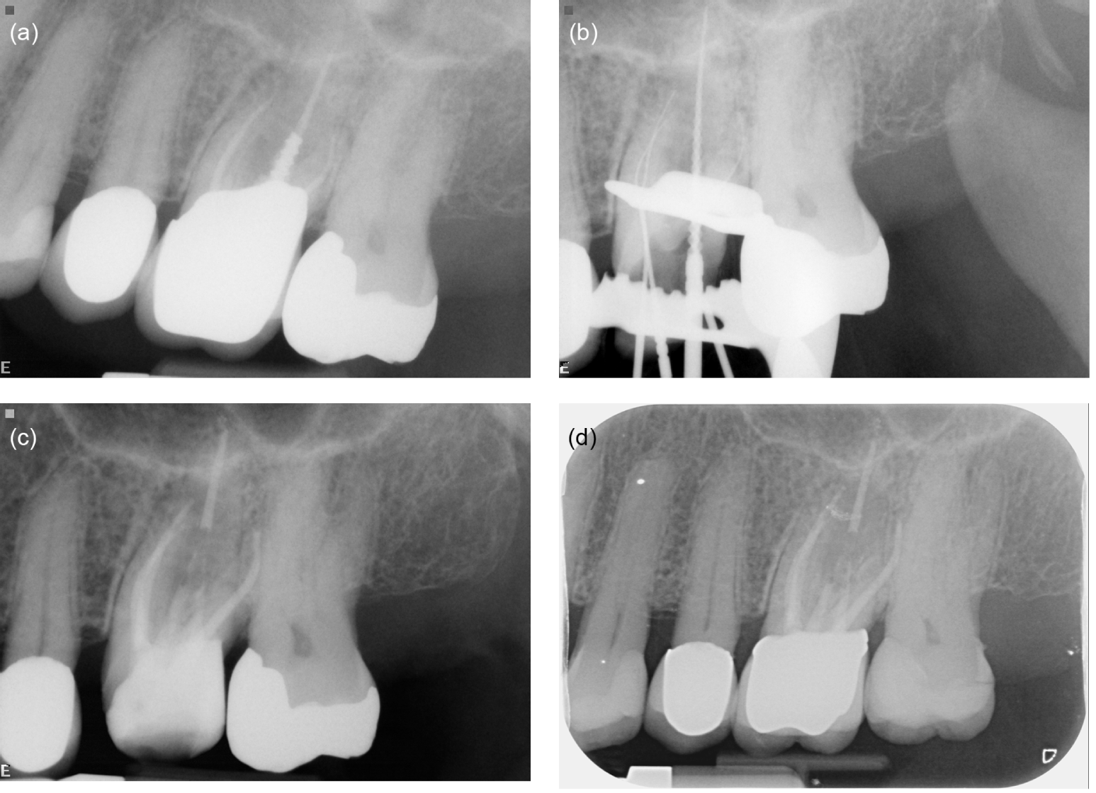 Detection Of Canal Orifices, Negotiation, And Management Of Calcified ...