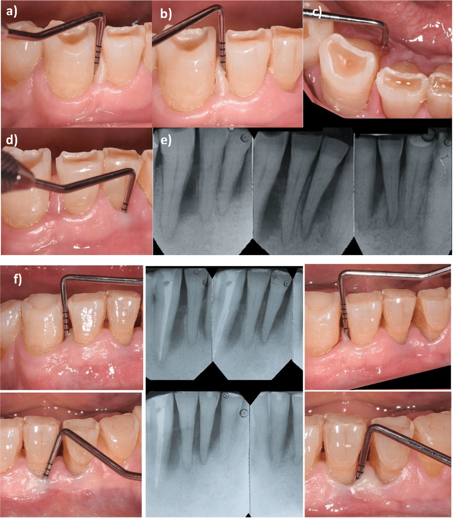 Classifications And Management Of Endodontic-periodontal Lesions ...