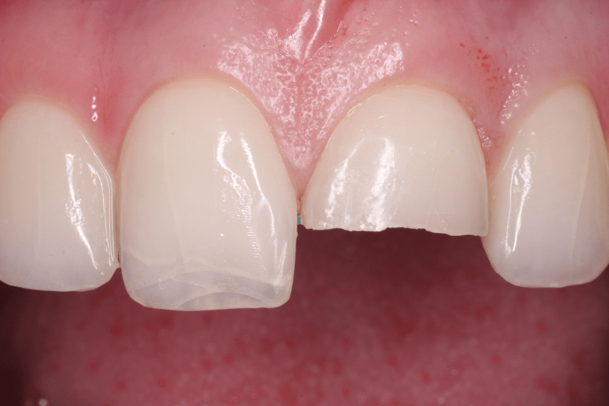 Management Of Traumatic Dental Injuries In The Permanent Dentition ...