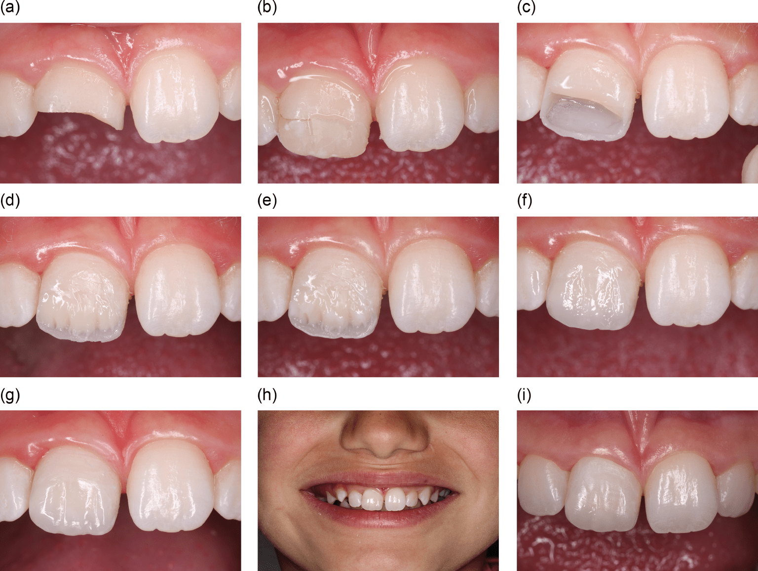 Management Of Traumatic Dental Injuries In The Permanent Dentition