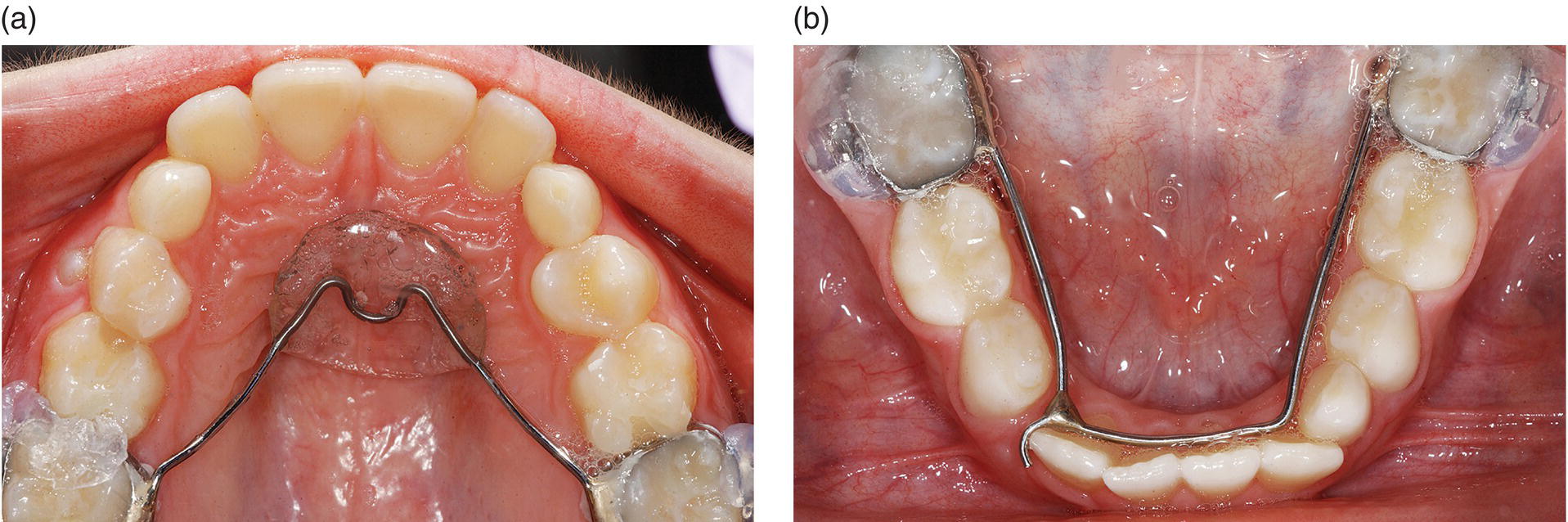 Crowding | Pocket Dentistry