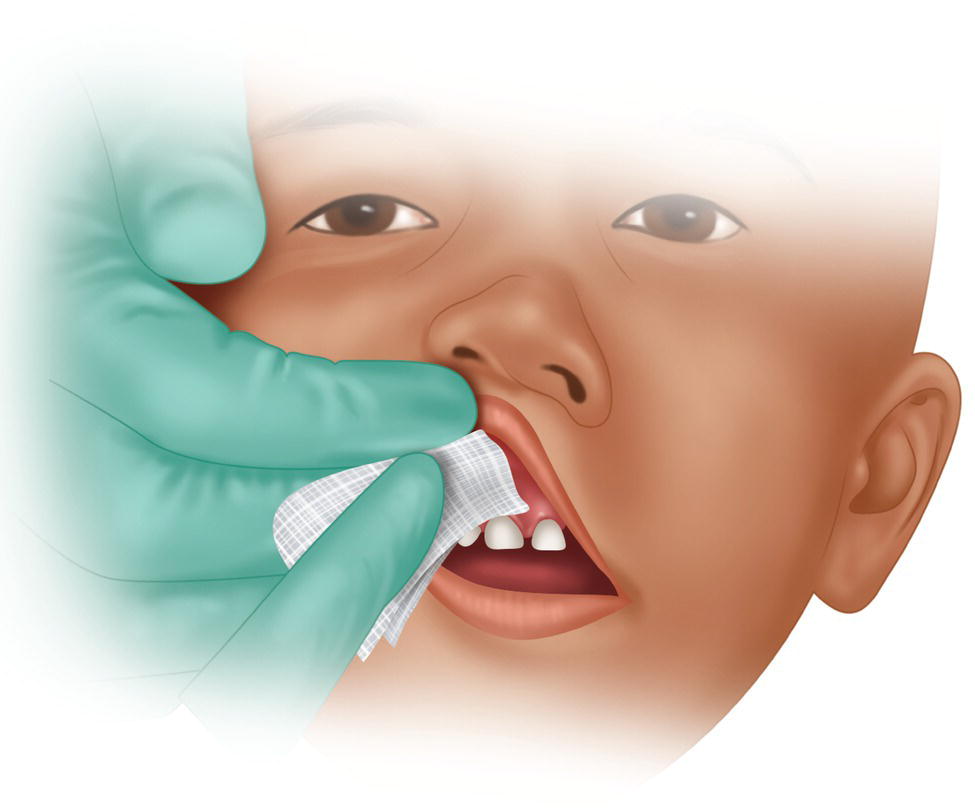An illustration of cleaning the oral mucosa area with a gauze.