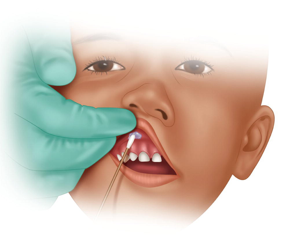 An illustration of applying the topical anesthesia in the oral mucosa area with a cotton swab.