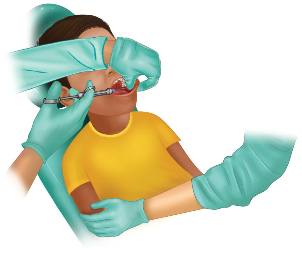 An illustration of injecting in a child's mouth. The hand of the dentist is holding the cheek and the assistant's arm is holding the child.