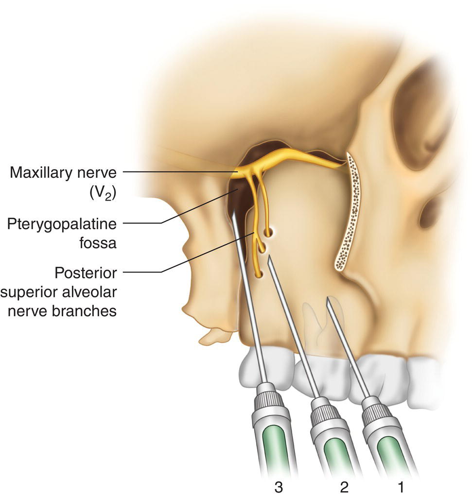 A schematic diagram of the injection of three needles around the maxillary nerve, pterygopalatine fossa, and posterior superior alveolar nerve branches.