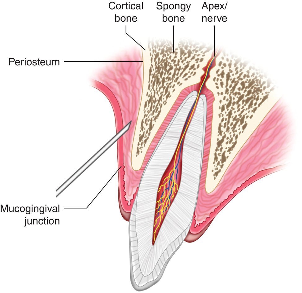An illustration of the injection of needle near the mucogingival junction, periosteum, cortical bone, spongy bone, and apex or nerve.