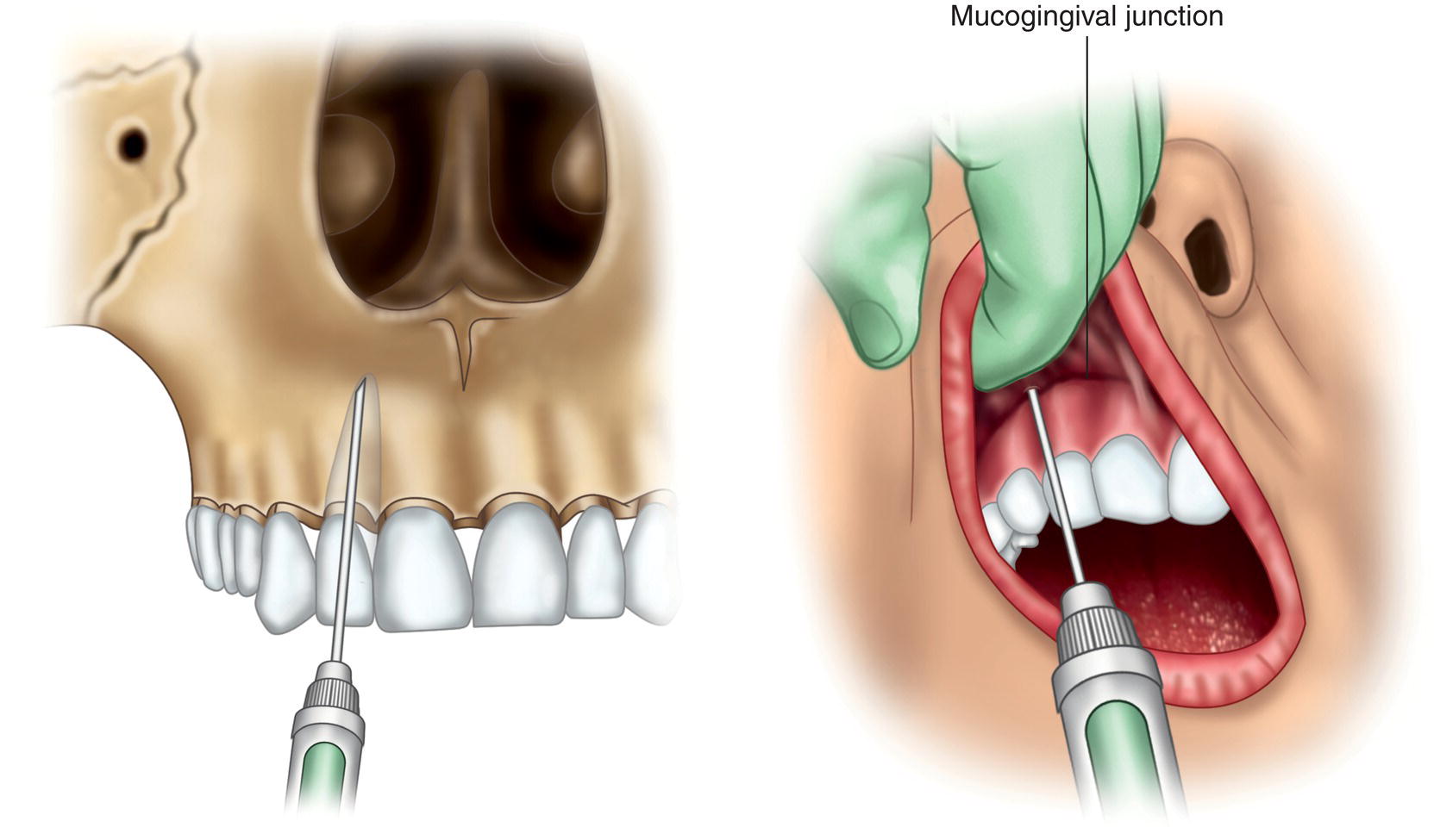 Two illustrations of the insertion of needle along the mucogingival junction in the anterior teeth of a skull and a human.