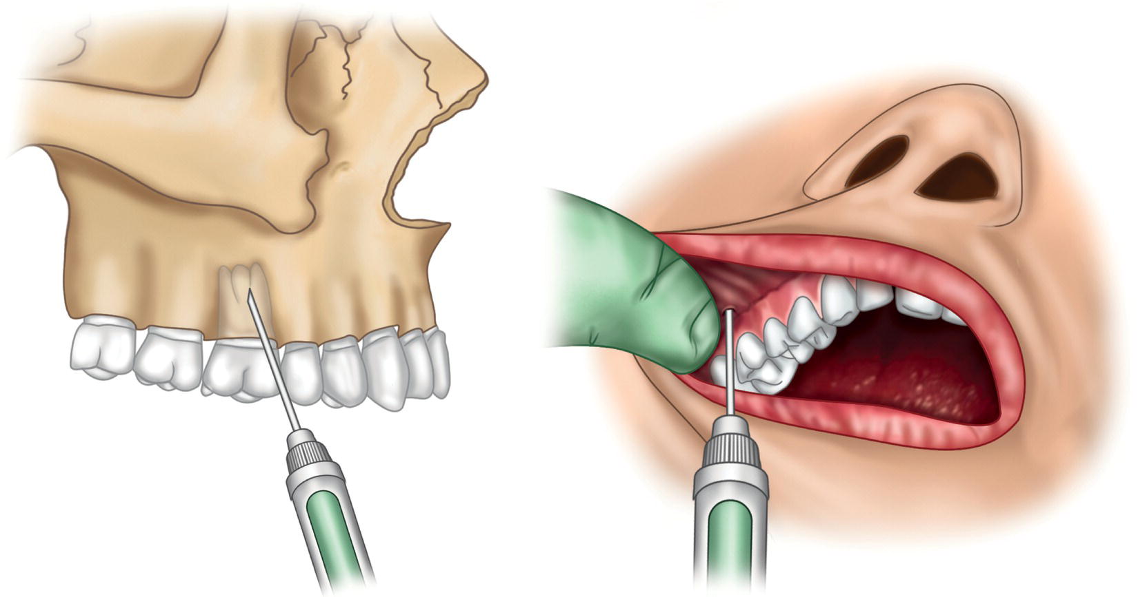 Two illustrations of the insertion of needle along the mucogingival junction in the molars of a skull and a human.