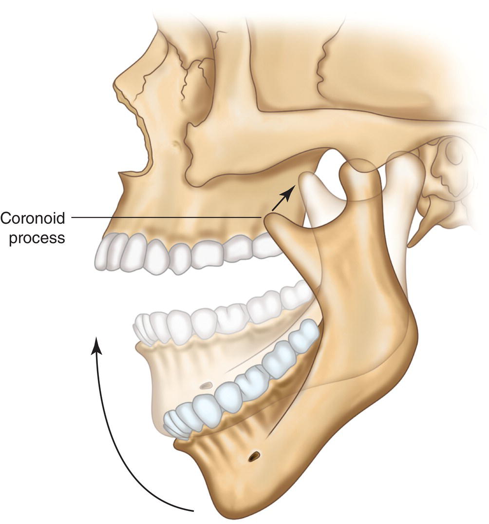 An illustration of a skull with the coronoid process in a partially closed mouth.