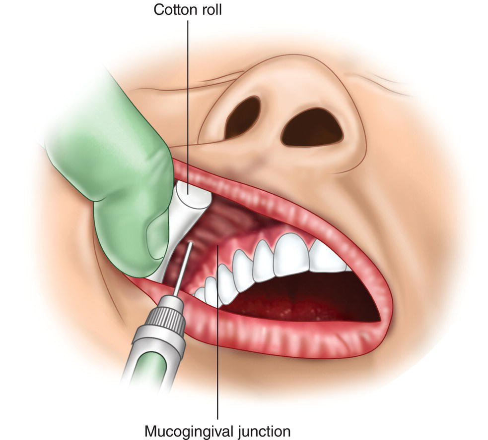 An illustration of placing a cotton roll in the roof of the buccal cavity.
