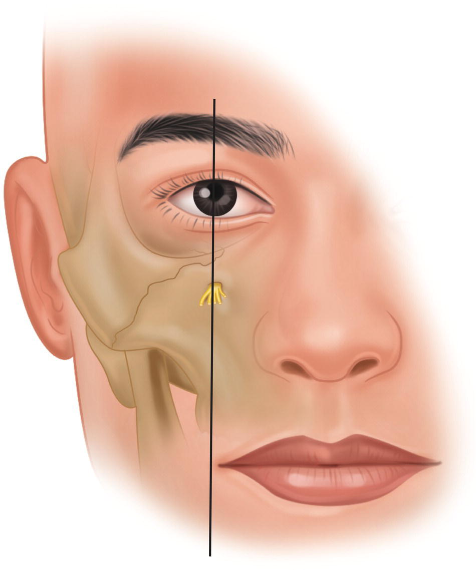 An illustration of infraorbital foramen in the vertical line through the center of the eye.