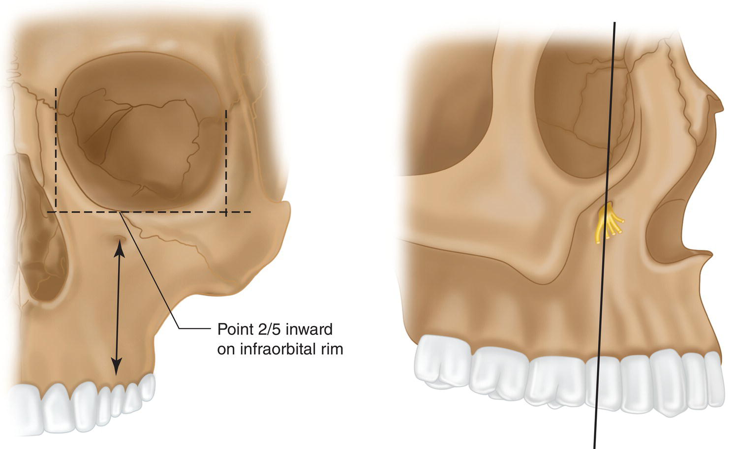An illustration of infraorbital foramen in the front and side views of a skull at a point two-fifths inward on the infraorbital rim.