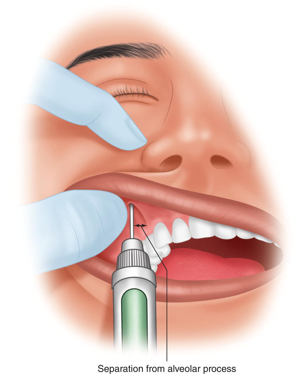An illustration of needle insertion by holding the upper lip and infraorbital foramen.