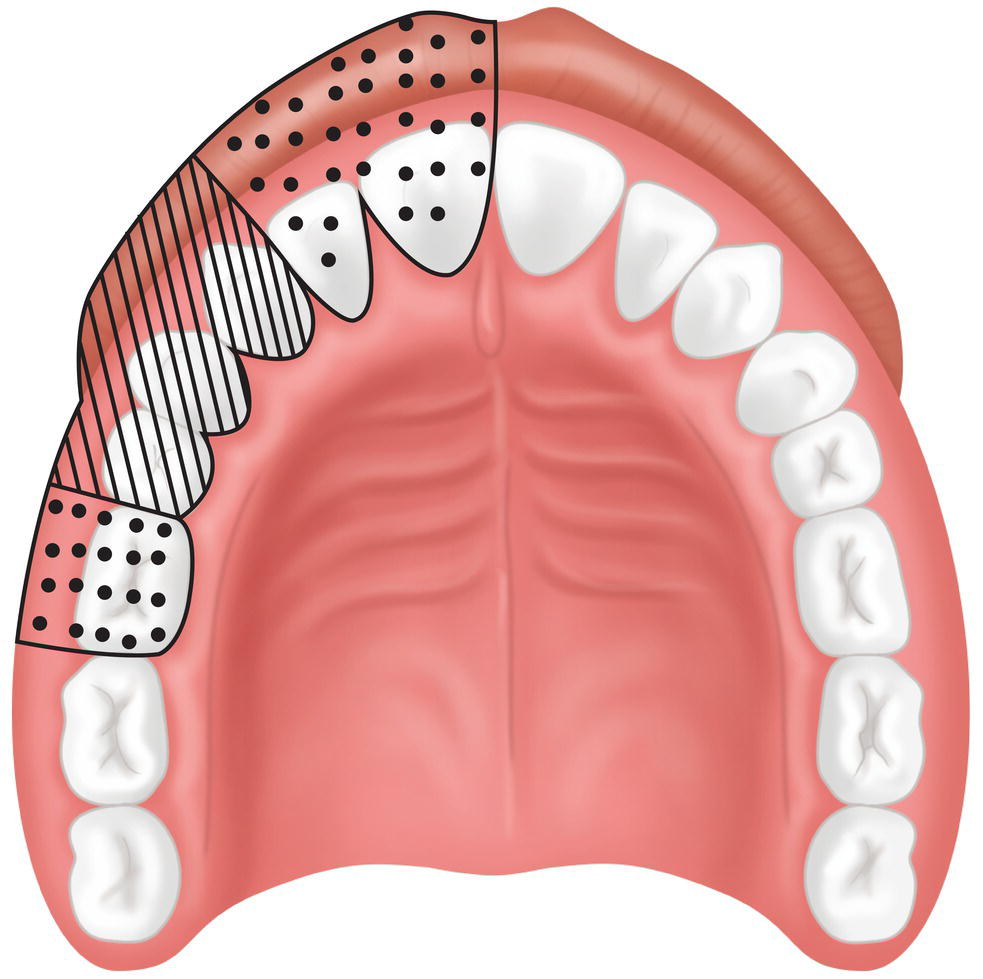 An illustration of the teeth with two different colors on the left.