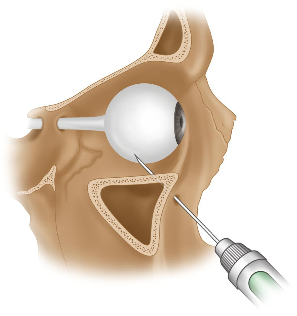 An illustration of needle penetration through the infraorbital formaen at the lower end of the eyeball.