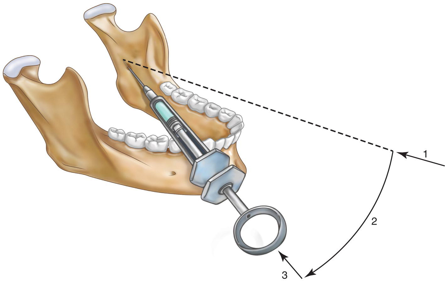 An illustration of insertion of needle in the buccal mucosa with mandibular block. The points are marked 1, 2, and 3 from right to left.