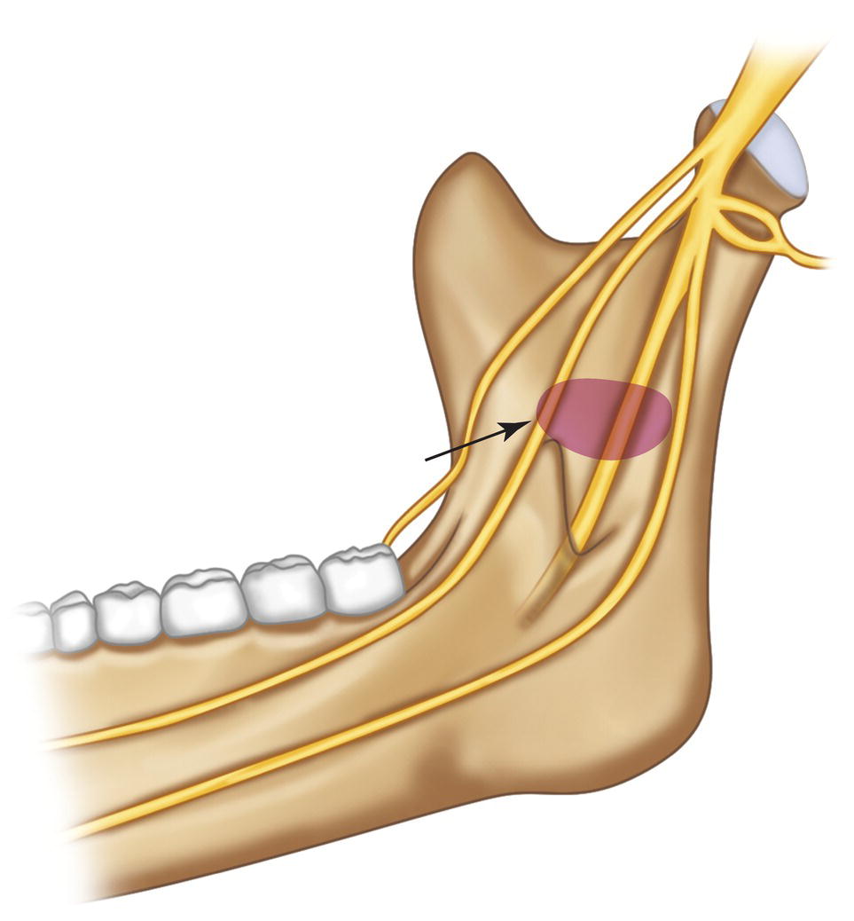 An illustration of the deposition of anesthetic solution in the mandibular block.