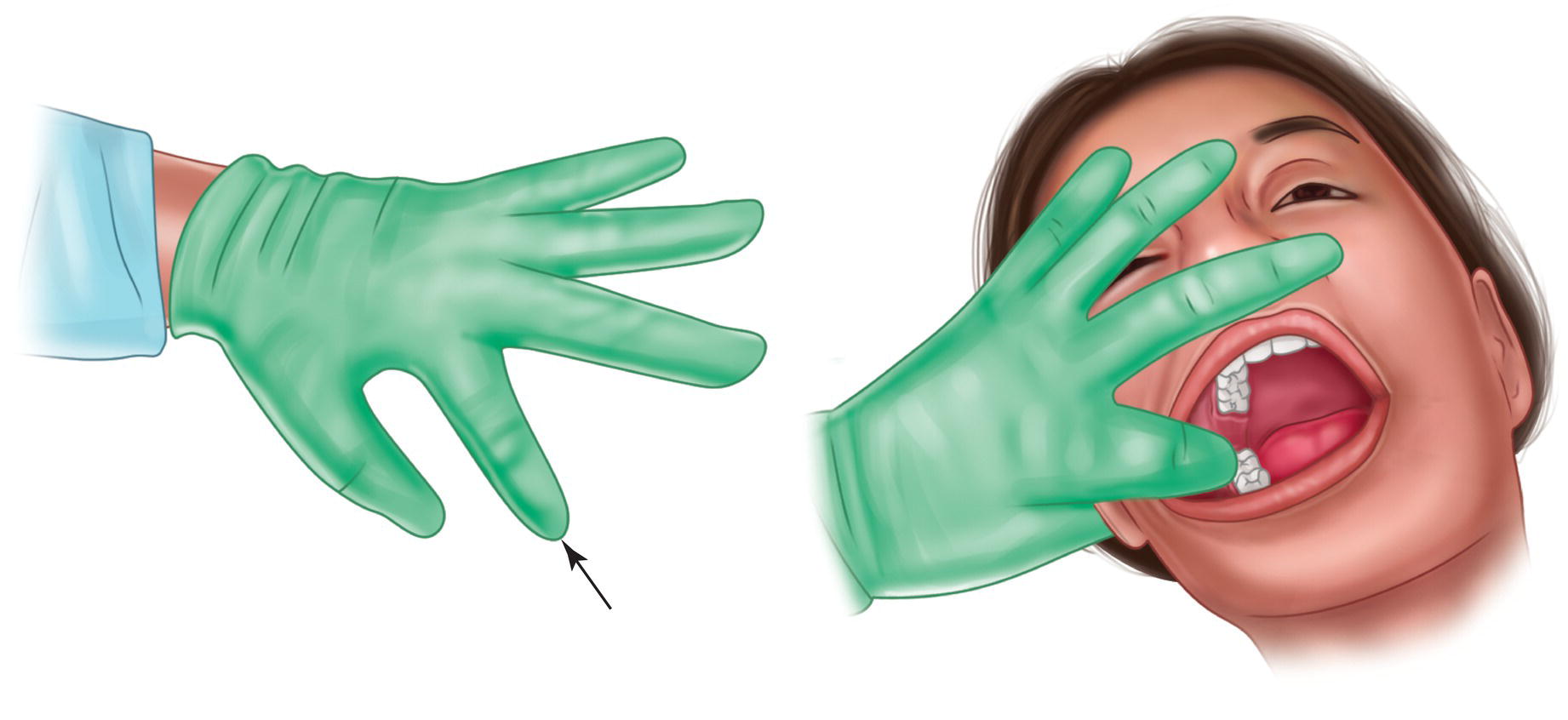 An illustration of bending the index finger and pulling the patient's cheek.