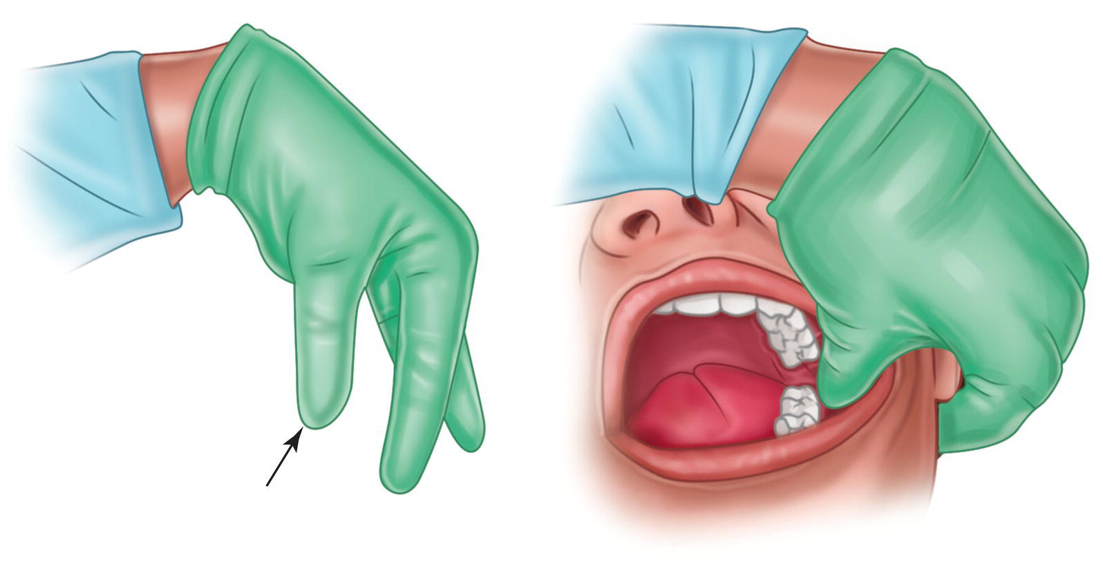 An illustration of bending the thumb and index finger and pulling the patient's cheek with the thumb.