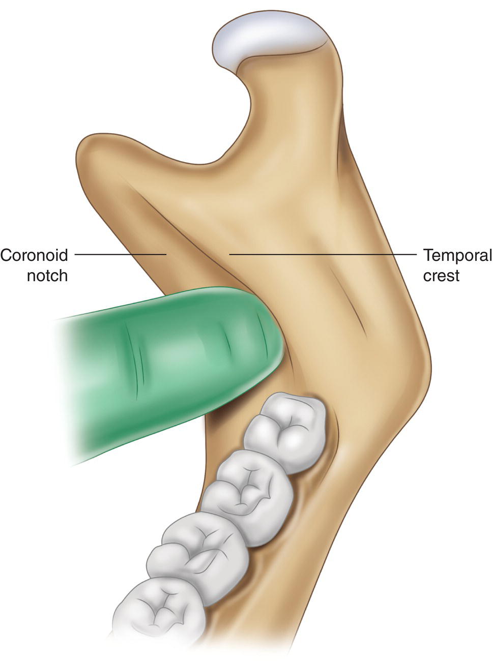 An illustration of placing the finger between the coronoid notch and temporal crest.