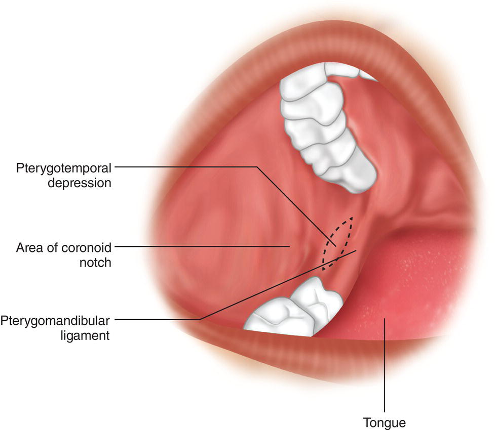 A schematic diagram indicates the pterygotemporal depression, area of coronoid notch, pterygomandibular ligament, and the tongue.