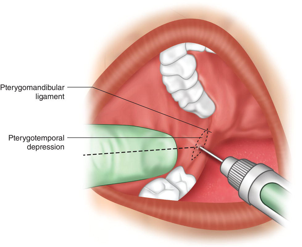 A schematic diagram indicates the insertion of needle below the pterygomandibular ligament and pterygotemporal depression.