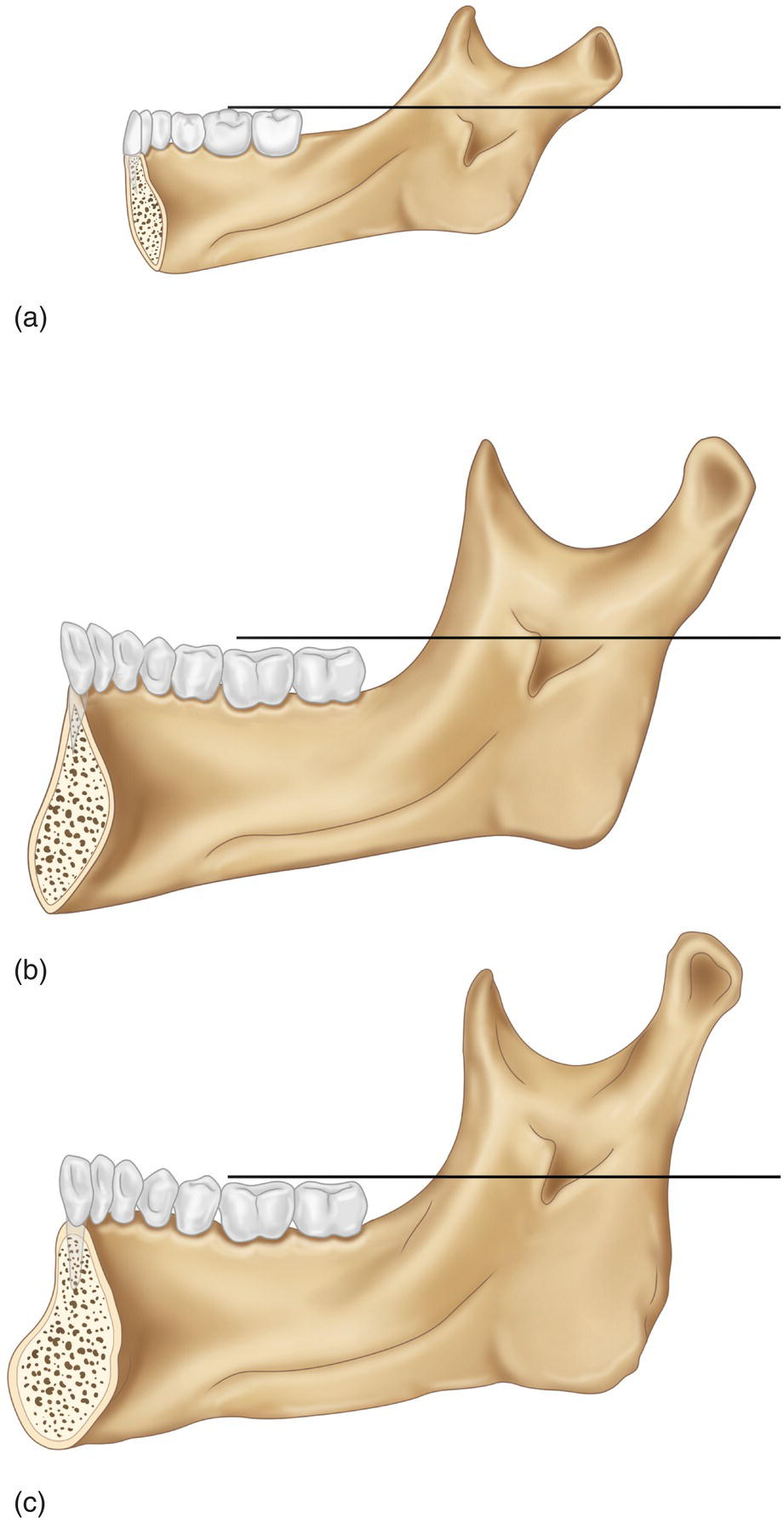 Three illustrations of the increasing lengths of the lingula in the occlusal plane from top to bottom.