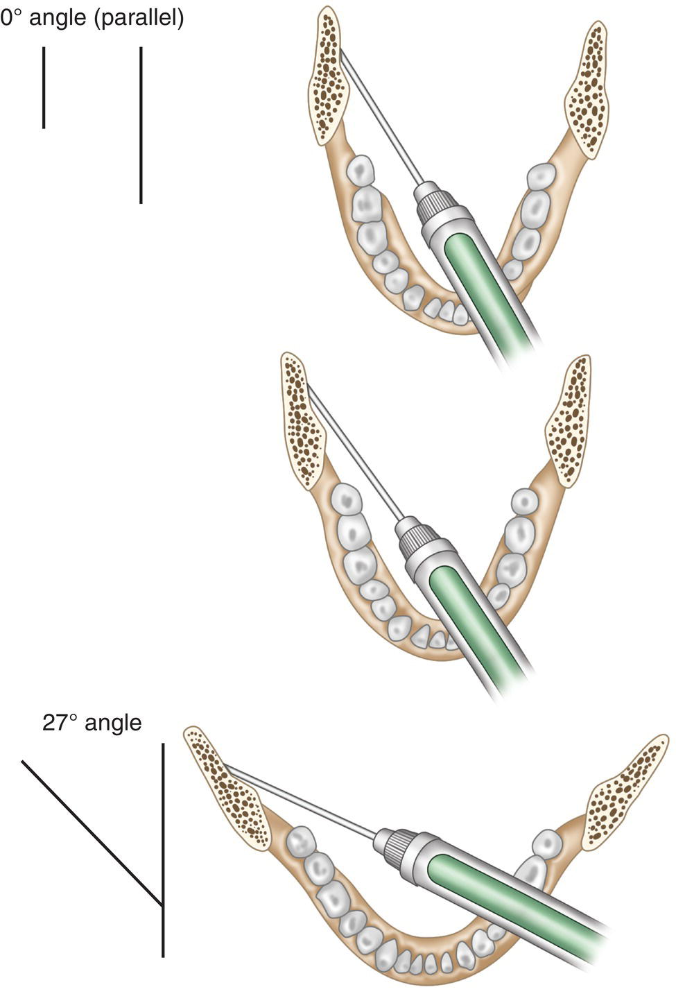 Three illustrations of syringe positioned at contralateral mandibular molars increasing angles from 0 to 27 degrees.