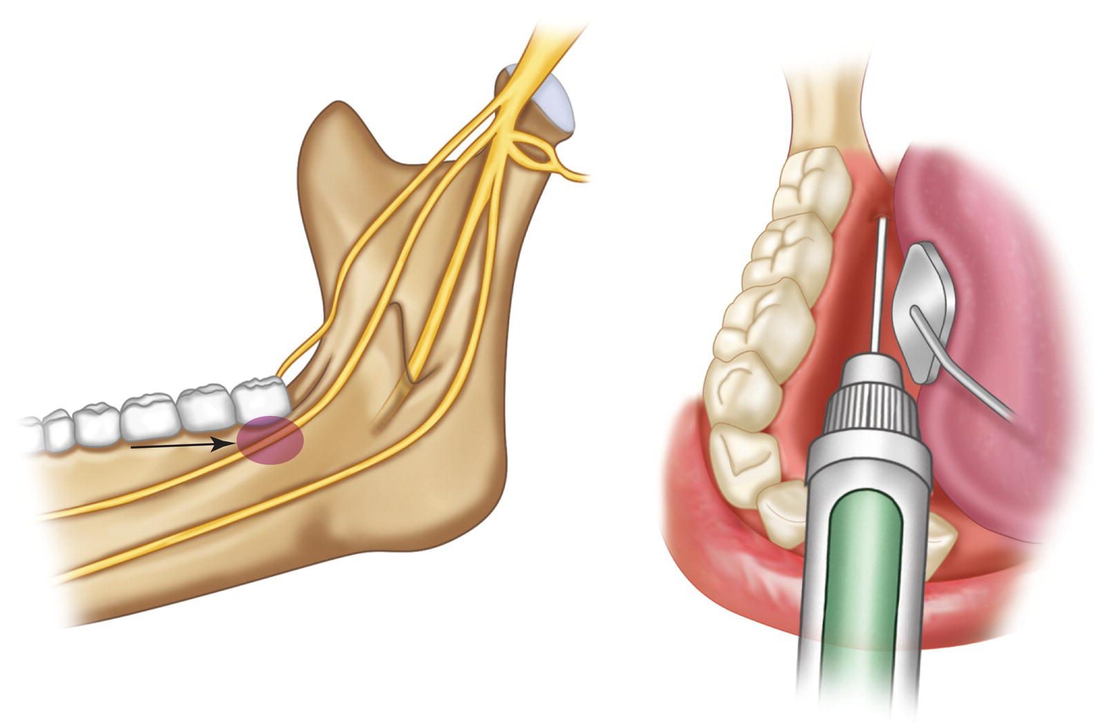 Two illustrations of the deposition of the anesthetic solution and the injection of anesthesia in the lingual nerve of the mandible.