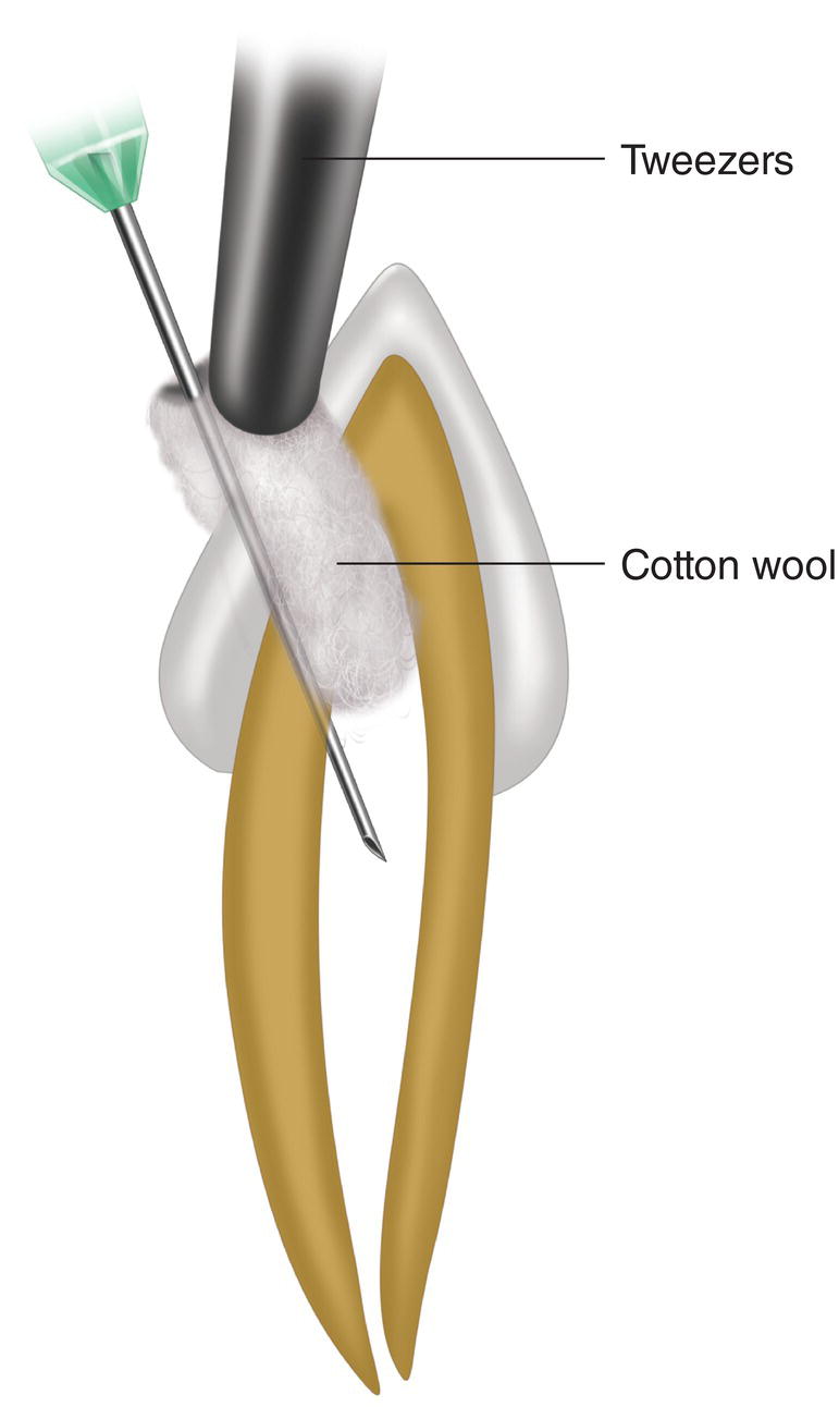 An illustration of needle insertion and placing a cotton ball with tweezers.