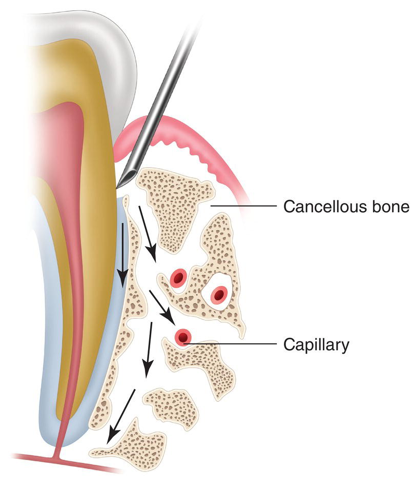 An illustration of needle insertion for the diffusion of capillary through the cancellous bone.
