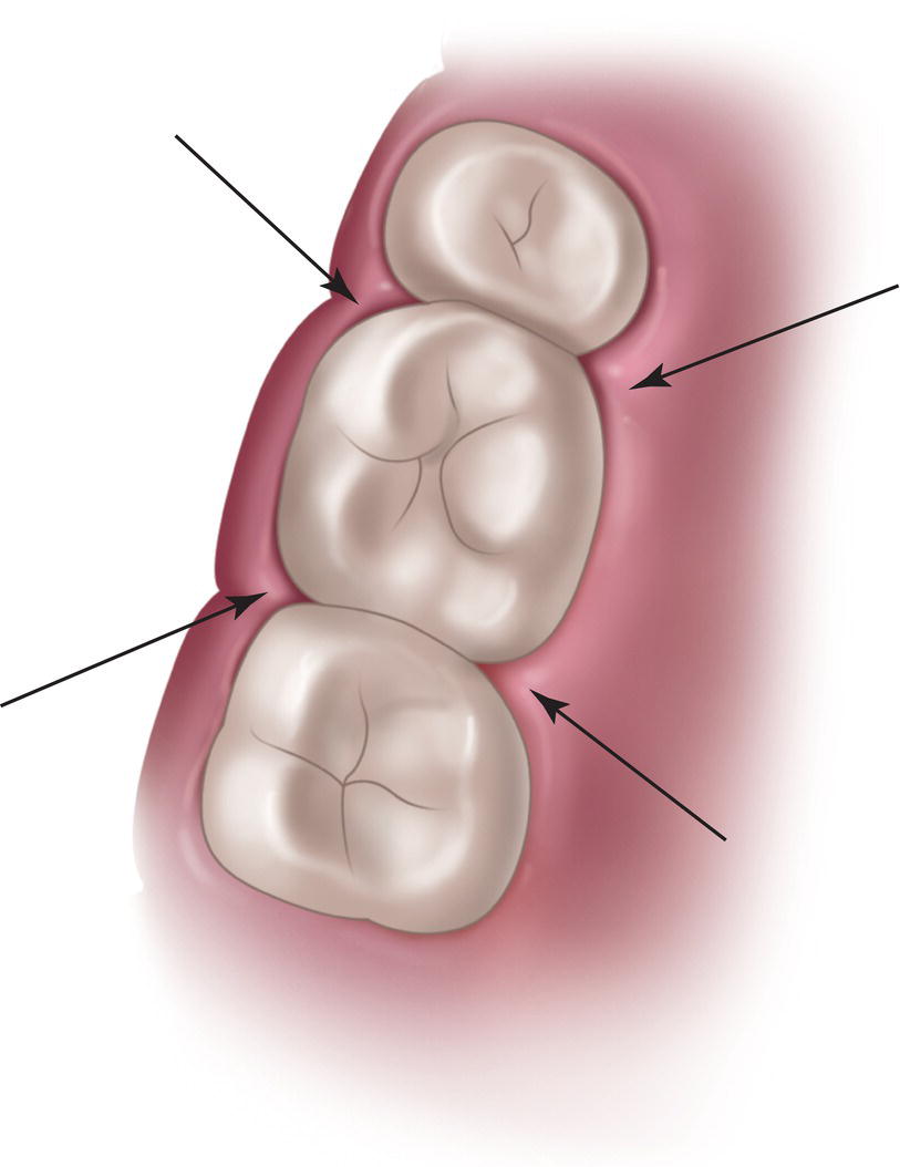 An illustration of four different angles of needle insertion in the anterior and posterior parts of the teeth.