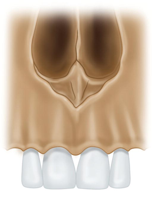 An illustration of the maxillary central incisors with thickened anterior nasal spine.