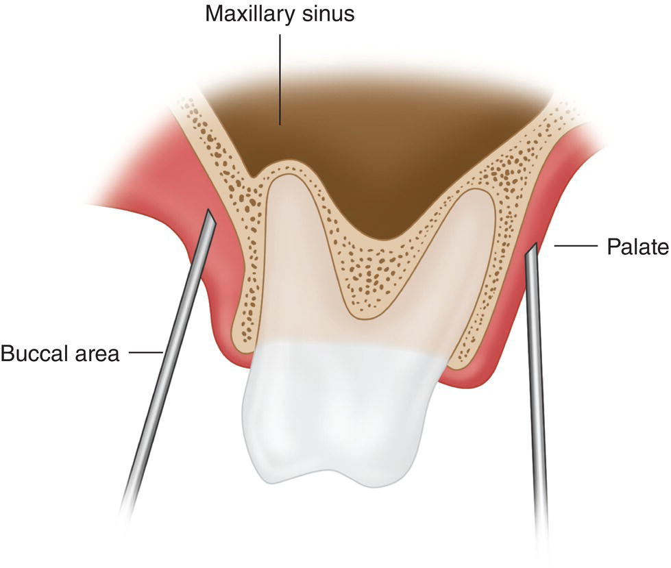 An illustration of the penetration of two needles in the maxillary sinus from the buccal area on the left and palate on the right.