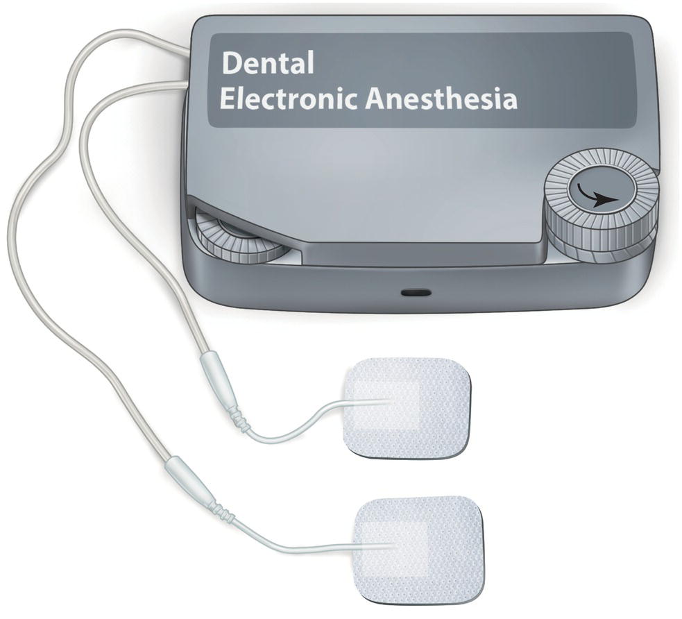 An illustration of a dental electronic anesthesia device with two external extrabuccal electrodes.