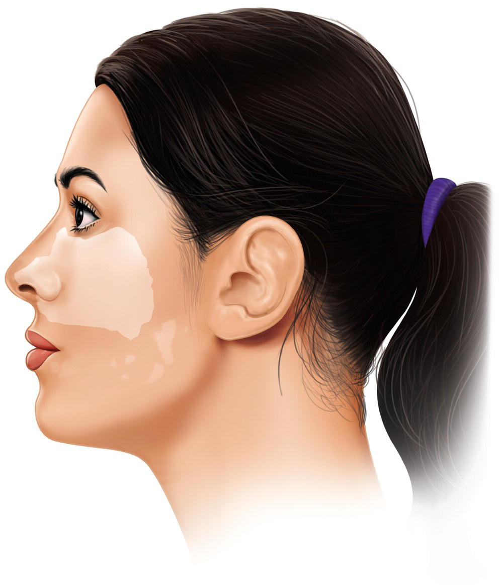An illustration of the side view of the face indicates the area from the nose to the cheek affected by facial blanching.