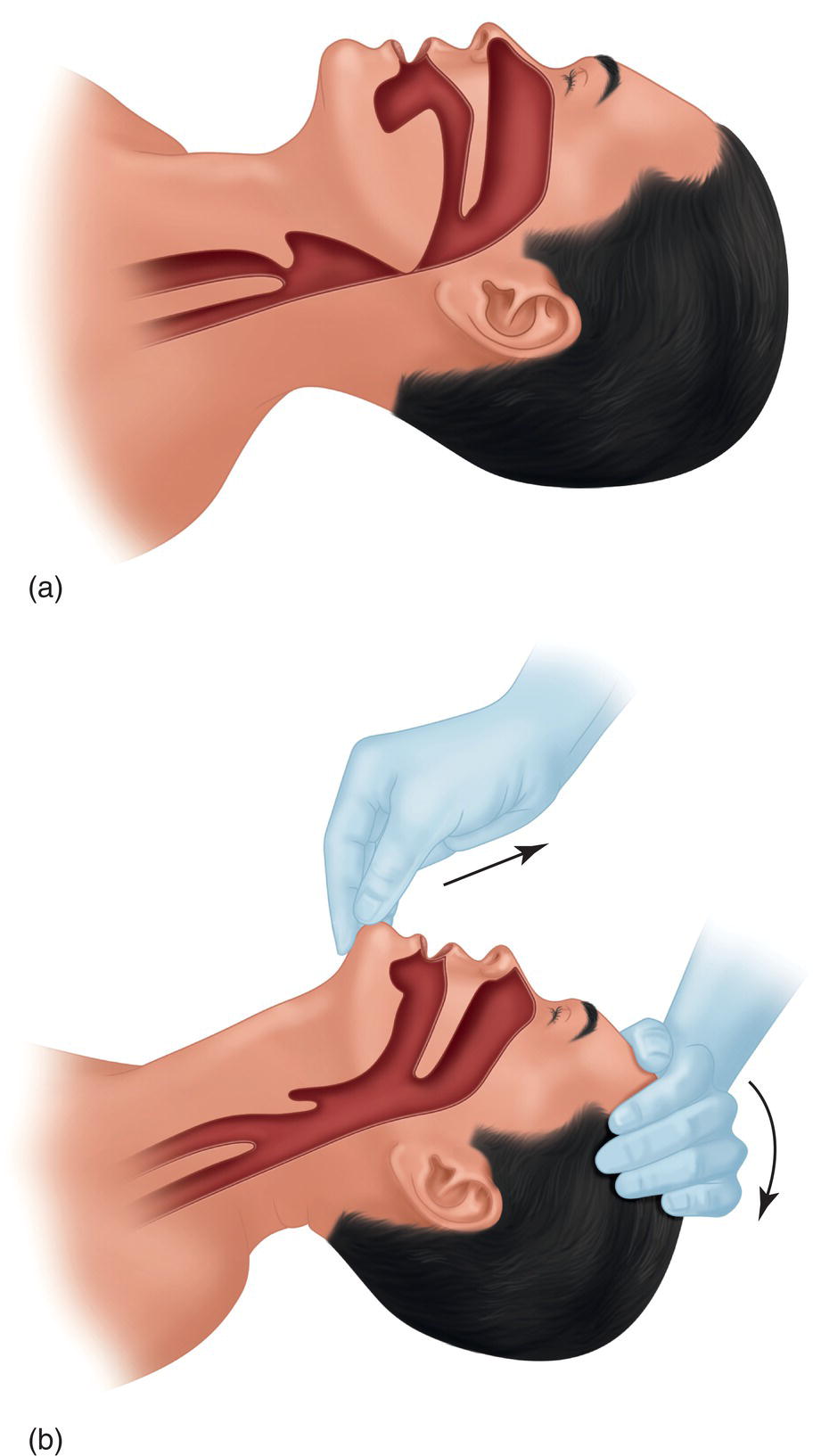 Two illustrations of closed airway with flat head and open airway with tilted chin.