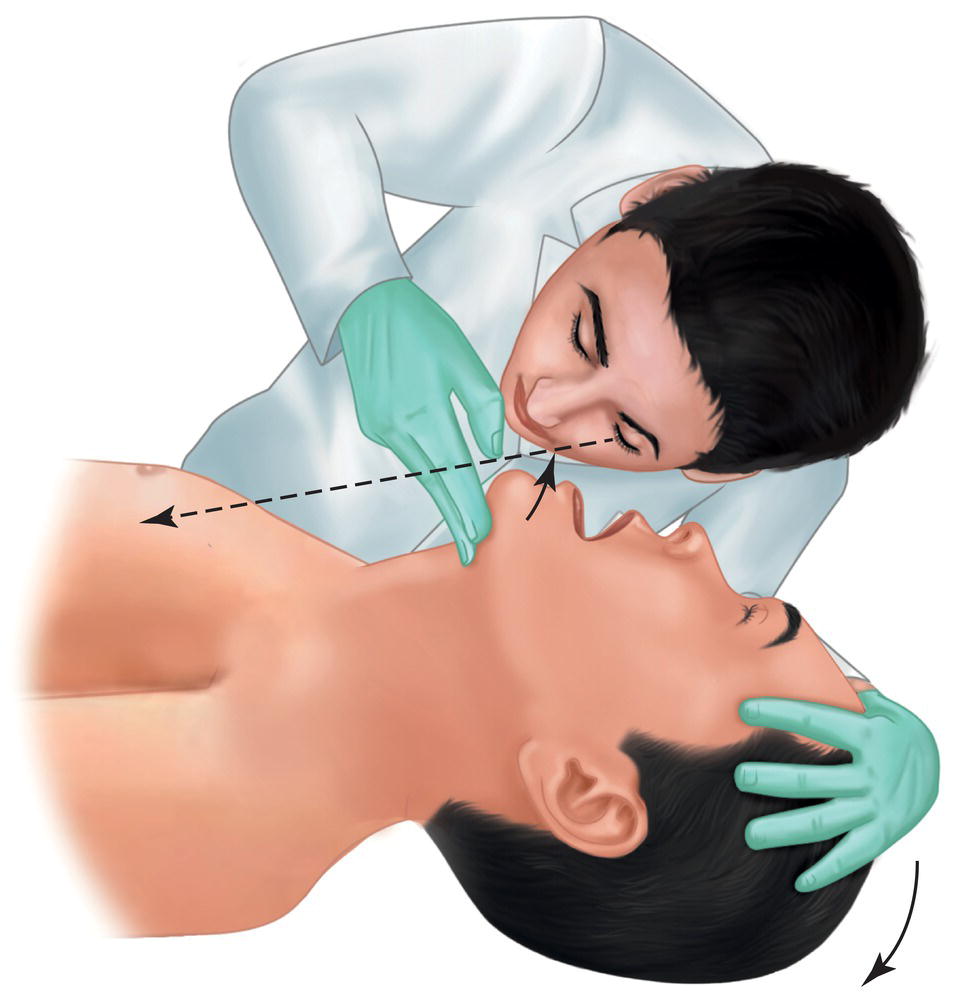 An illustration of a doctor listening to the air flow of a patient lying in the head tilt-chin lift position.