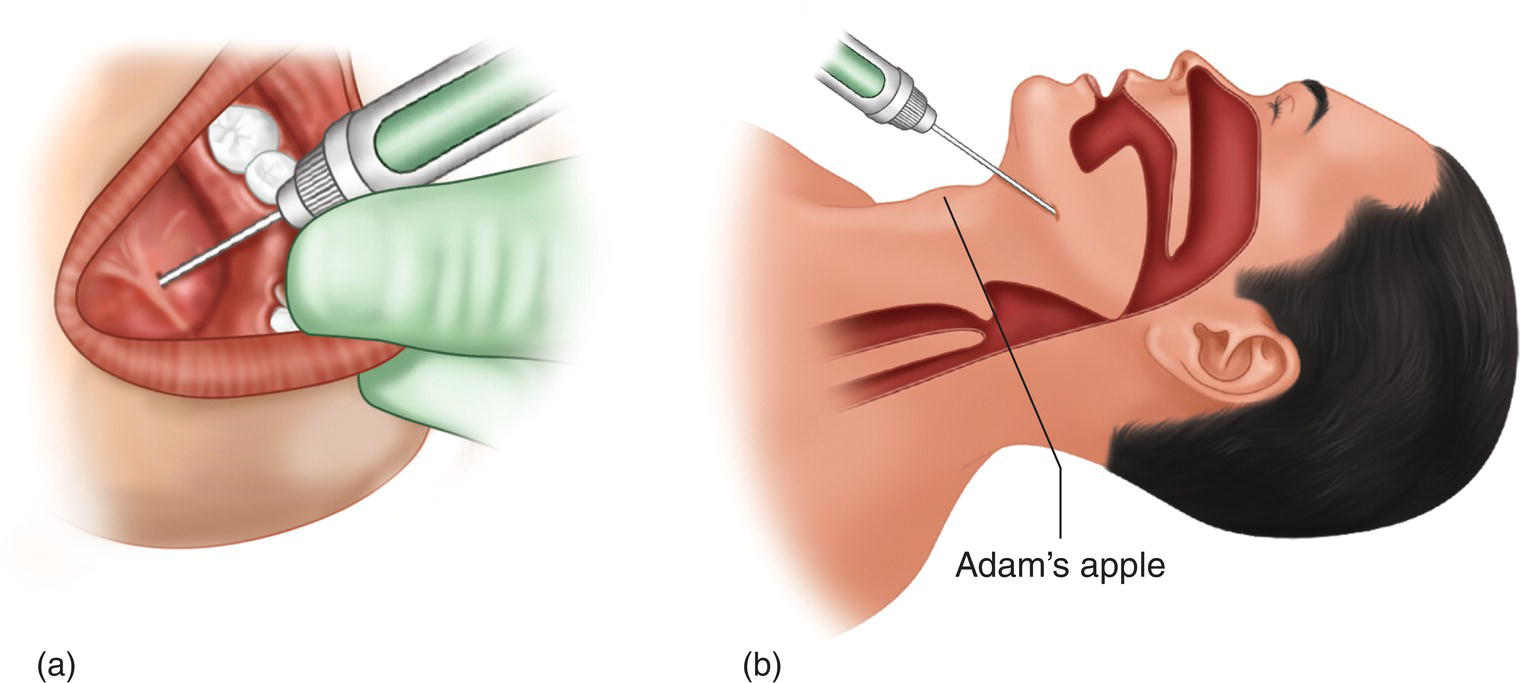 Two illustrations of injection under the tongue and in the Adam's apple.
